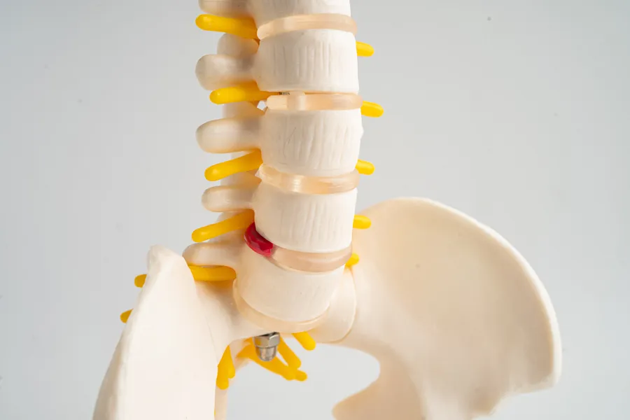 Slipped disc Osteopathy in Worthing